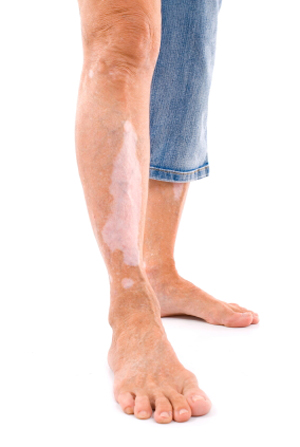 prekrijte-vitiligo-coverdermom