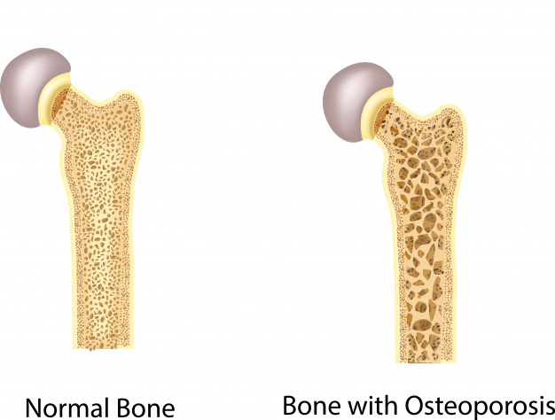 Što je osteoporoza?