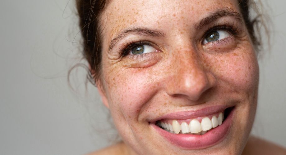 Melanin se može nakupiti, uzrokujući da to područje izgleda tamnije, odnosno pojavu pjegica/mrlja.