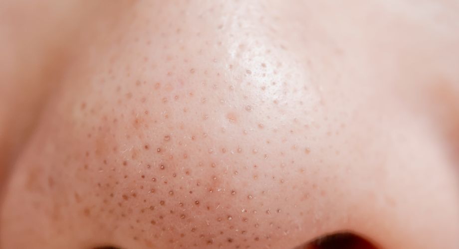 Kad se pore začepe, a sebum dođe u dodir sa zrakom, dolazi do oksidacije, zbog čega nastaju crni miteseri.